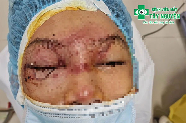 Mẹ bơm xe bị nổ lốp, mảnh vỡ bắn thẳng vào hỏng mắt con trai